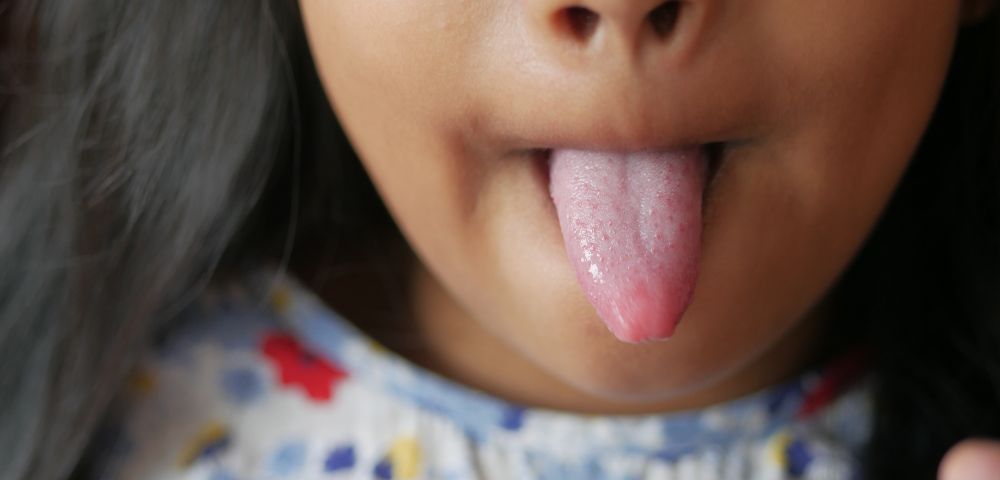 photo of child poking tongue out, as we discuss why tongue posture matters