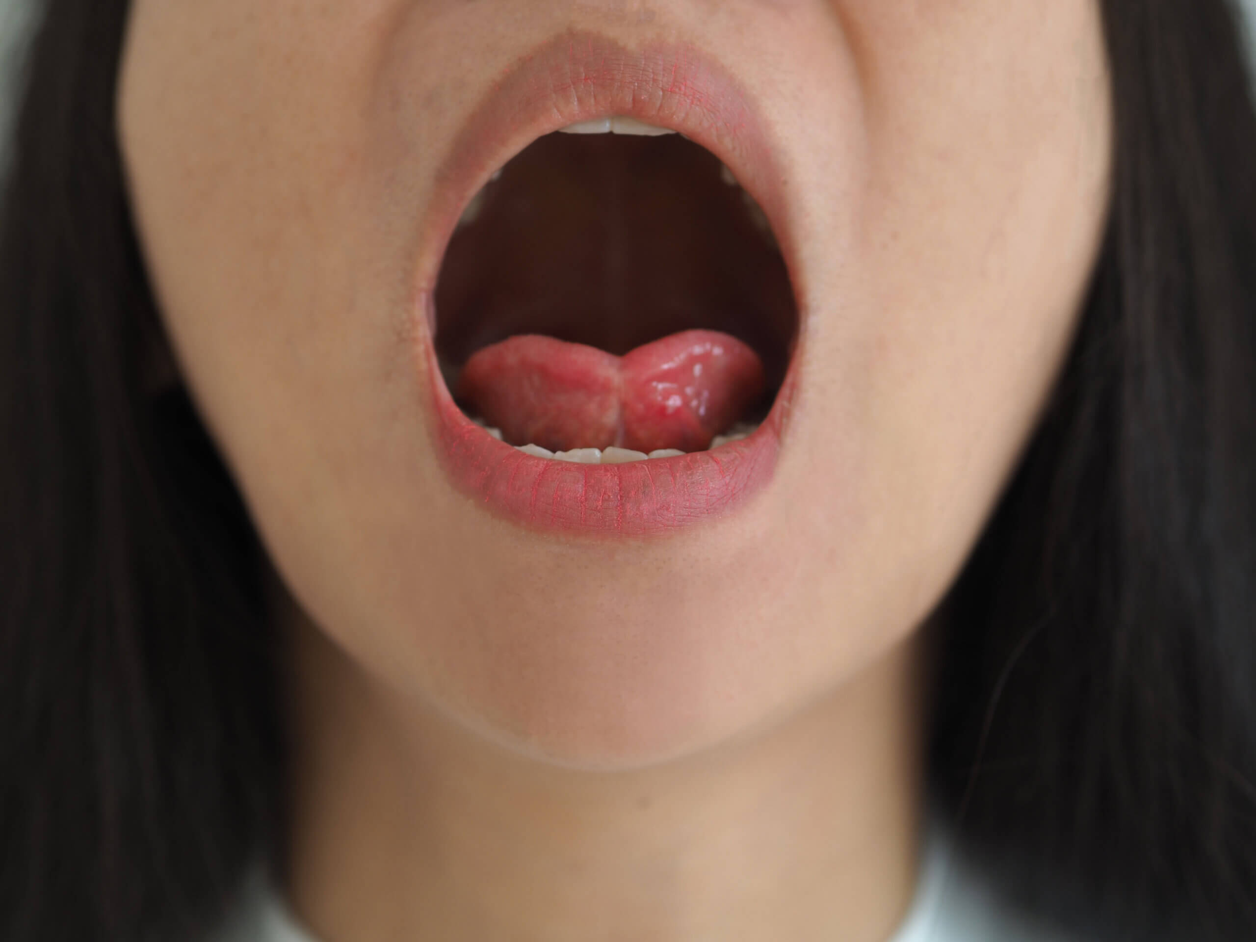 ankyloglossia in asian woman and cause of an unusually short of